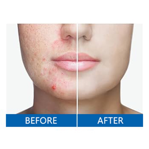 High Quality Preservatives for Acne Wipes  Facial Cleansing Wet Wipes/ Cosmetics / Formula Technology